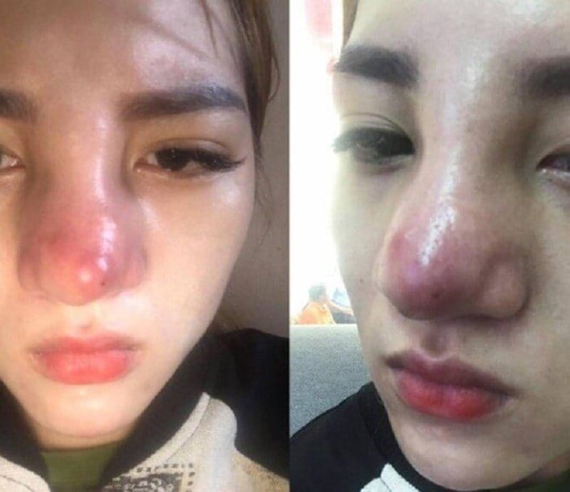 nâng mũi chỉ có hại không