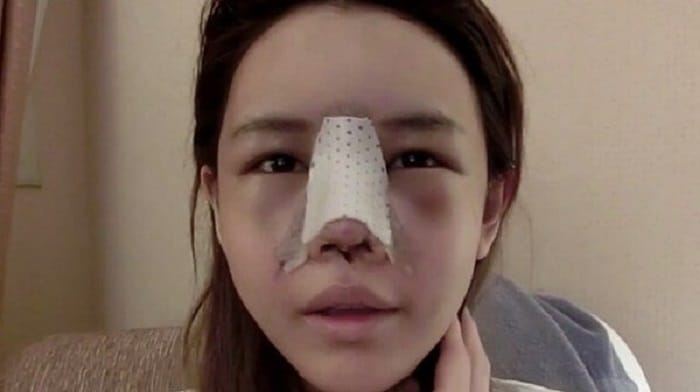 những điều cần tránh sau nâng mũi