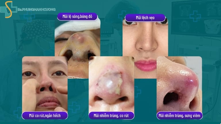 sửa mũi hỏng ở đâu