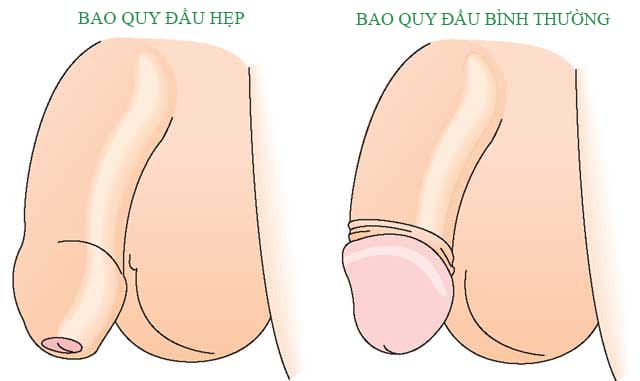 hẹp bao quy đầu có nguy hiểm không