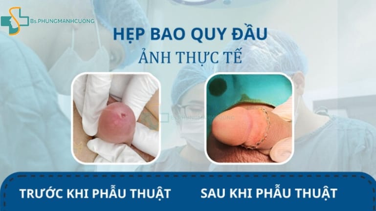 hẹp bao quy đầu có quan hệ được không