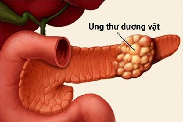 Cách phát hiện sớm viêm bao quy đầu ở nam giới 8 ung thu duong vat