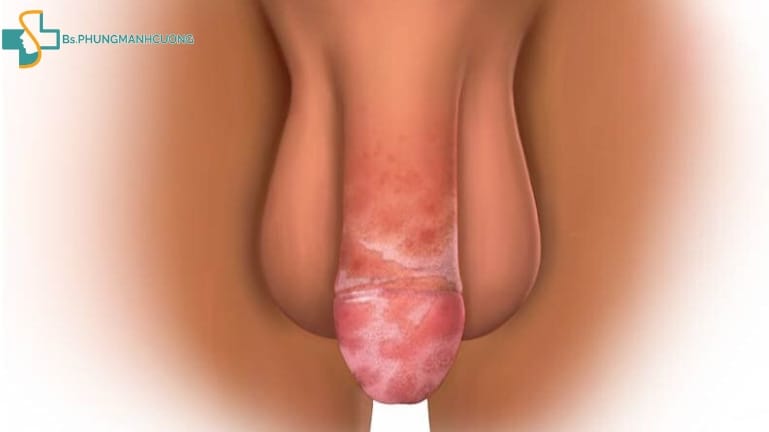 Cách phát hiện sớm viêm bao quy đầu ở nam giới 6 viêm bao quy đầu