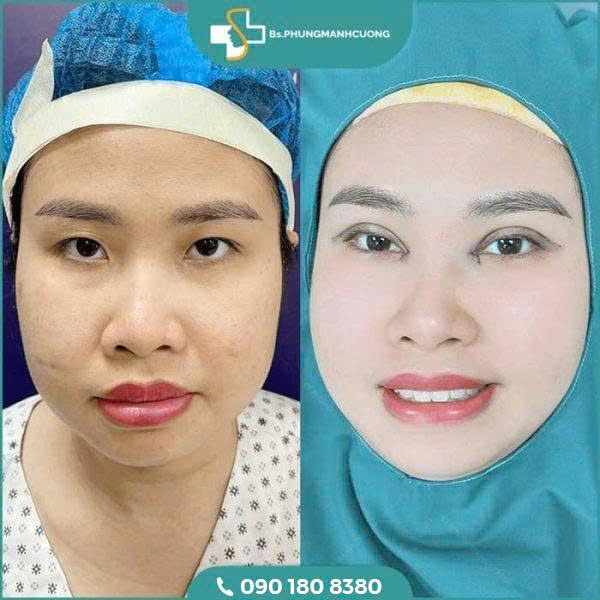 Có nên cắt mí không? Lời khuyên trước khi lựa chọn 7 z6643235936552 00a55ff7e5ca235df2cd54b8d0604961