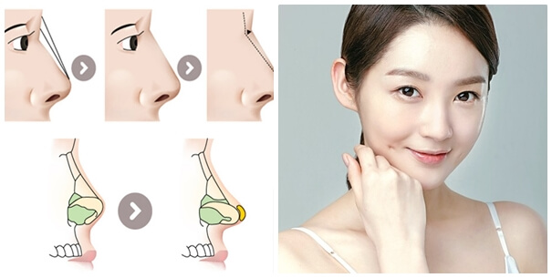Nâng mũi cấu trúc là gì mà được ưa chuộng đến thế? 5 Nâng mũi cấu trúc là gì