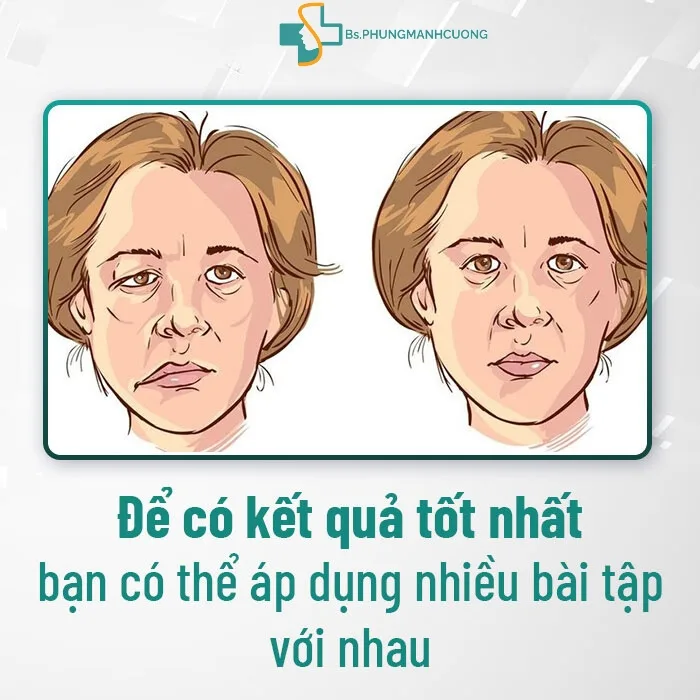 Nguyên nhân gây liệt dây thần kinh số 7 và cách nhận biết 9 bai tap liet day than kinh so 7 1.jpg