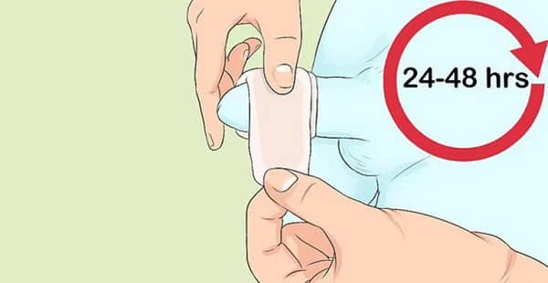 Giới thiệu phương pháp cắt bao quy đầu đẹp tự nhiên, an toàn 9 cham soc sau cat bao quy dau