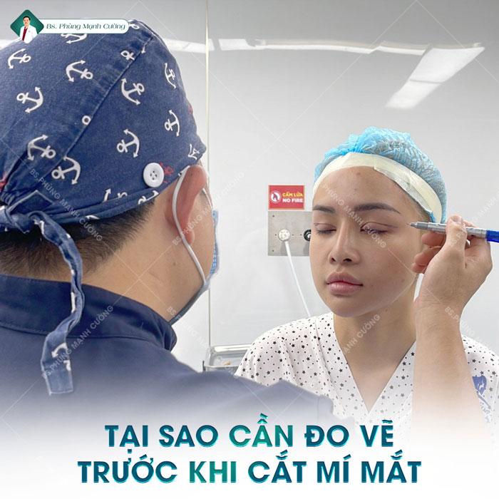 Cắt mí có đau không? Tư vấn từ bác sĩ thẩm mỹ uy tín 8 do ve mi mat