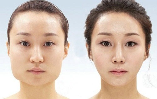 Phẫu thuật gọt hàm: Giải pháp cho khuôn mặt thon gọn V-line 6 got ham tao mat v line cho mat vuong