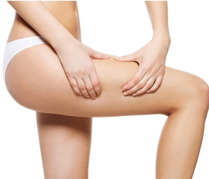 Hút mỡ đùi không phẫu thuật là gì? Tìm hiểu chi tiết về phương pháp thẩm mỹ hiện đại 5 Hút mỡ đùi không phẫu thuật