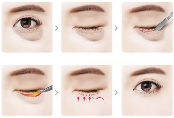Lấy mỡ bọng mắt: Bí quyết gìn giữ nét thanh xuân 8 image568