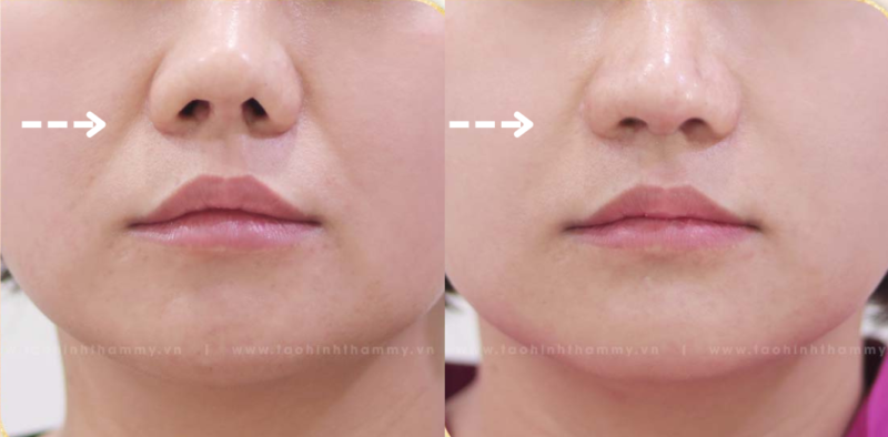 Thẩm mỹ đầu mũi - Bí quyết sở hữu dáng mũi thanh thoát 5 Thẩm mỹ đầu mũi là gì?