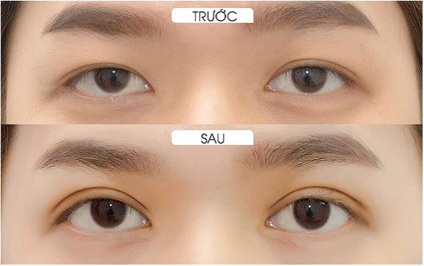 Trước và sau phẫu thuật cắt mí