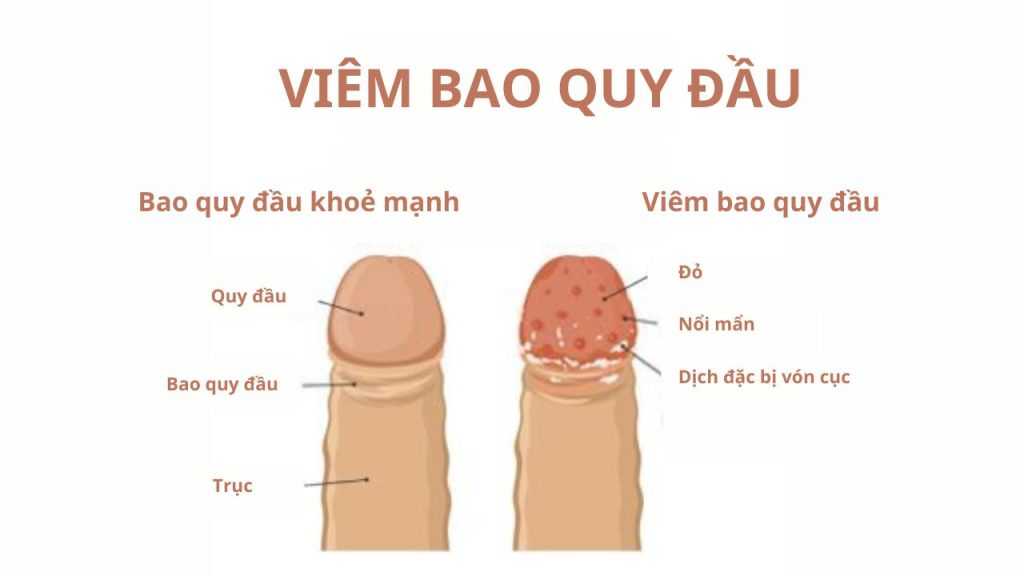 Dấu hiệu viêm bao quy đầu và giải pháp điều trị hiệu quả 5 Dấu hiệu viêm bao quy đầu