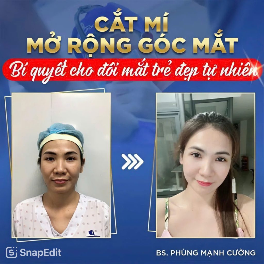 Bí quyết sở hữu đôi mắt to tròn nhờ phẫu thuật mở rộng góc mắt 7 z6657178961823 9dd6ef13b25d2cb951bea6ece7e97ea1