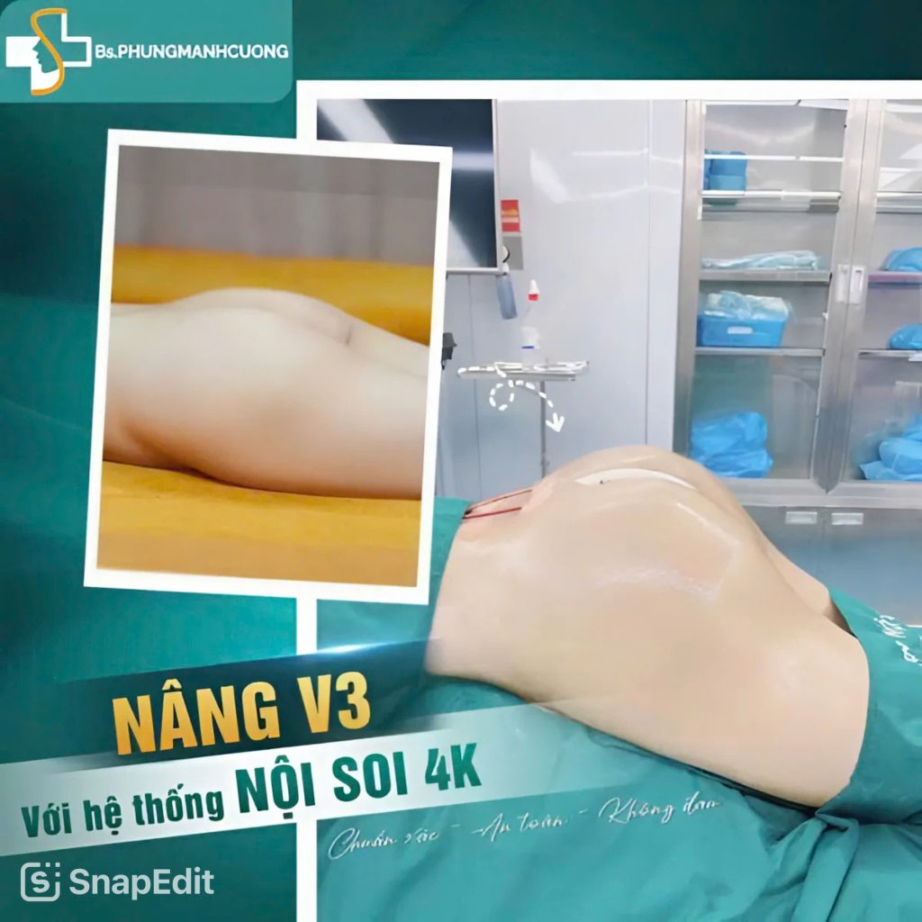 Vòng 3 căng tròn nhờ công nghệ nâng mông nội soi hiện đại 6 nâng mông nội soi