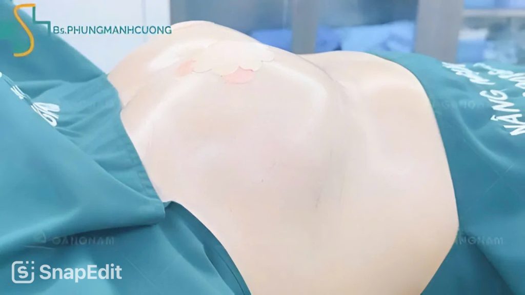 Nâng ngực có đau không? Chuyên gia giải đáp thắc mắc 6 Nâng ngực có đau không?