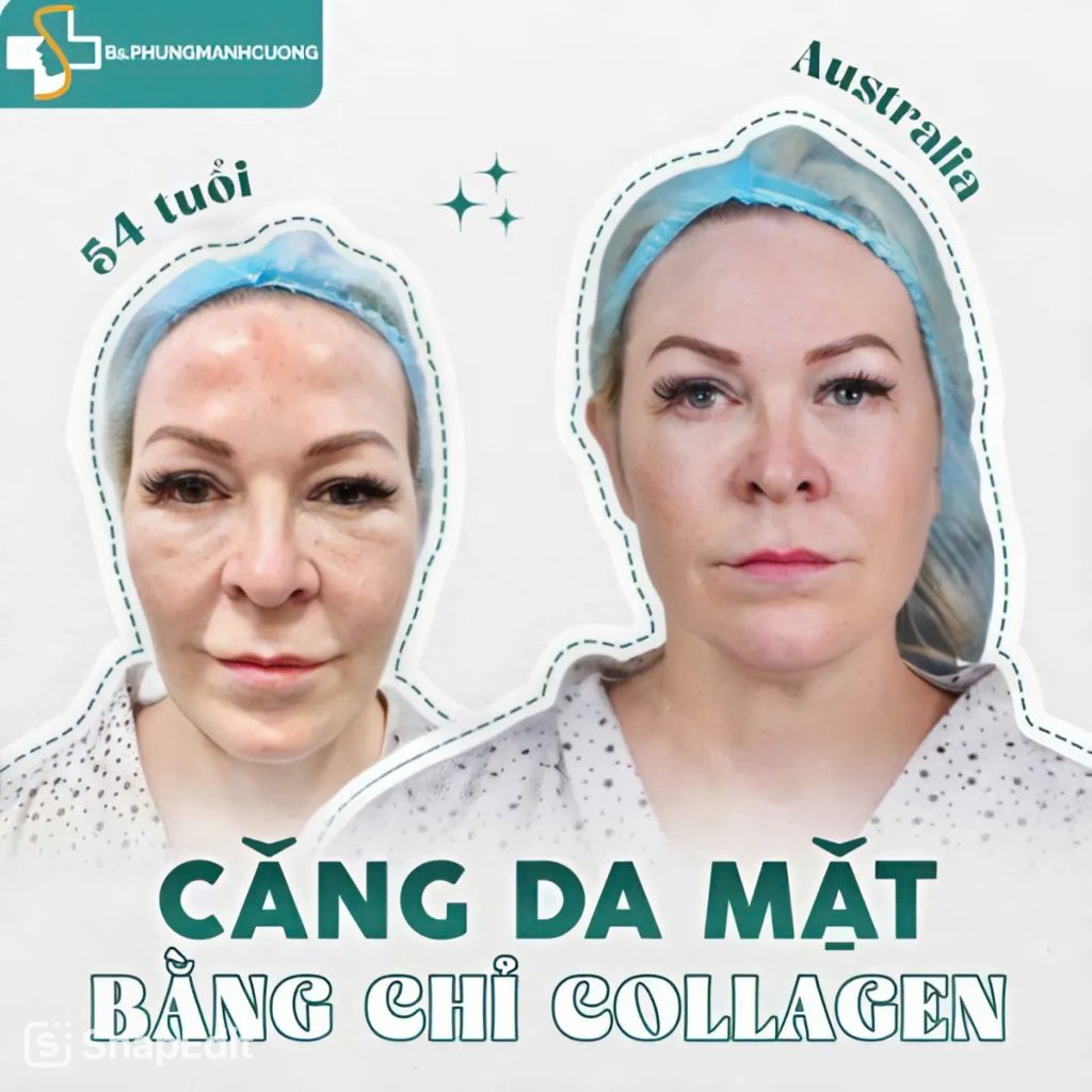 Căng da mặt bằng chỉ collagen