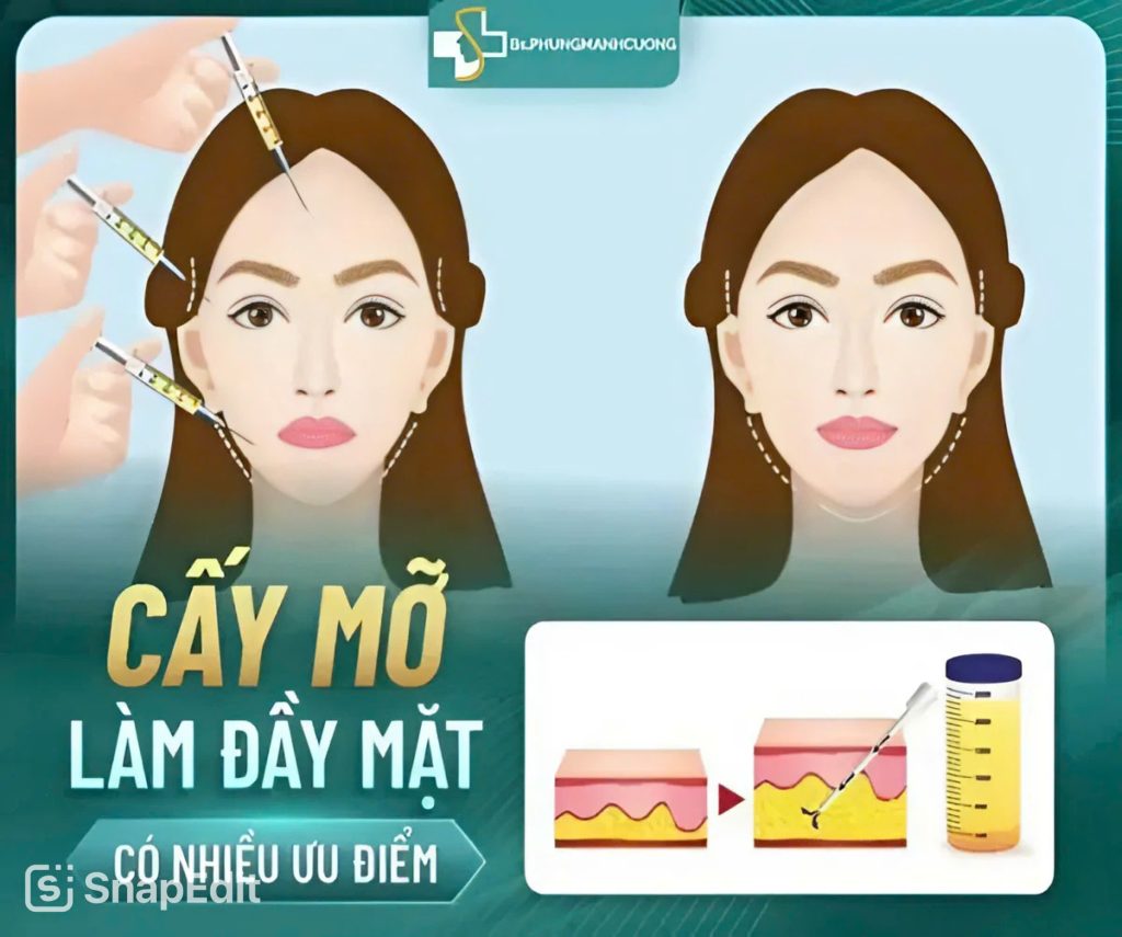 Vì sao cấy mỡ mặt ngày càng được ưa chuộng trong thẩm mỹ? 7 z6687732395423 2ce8d6b86fe0845f75c9420841b43944