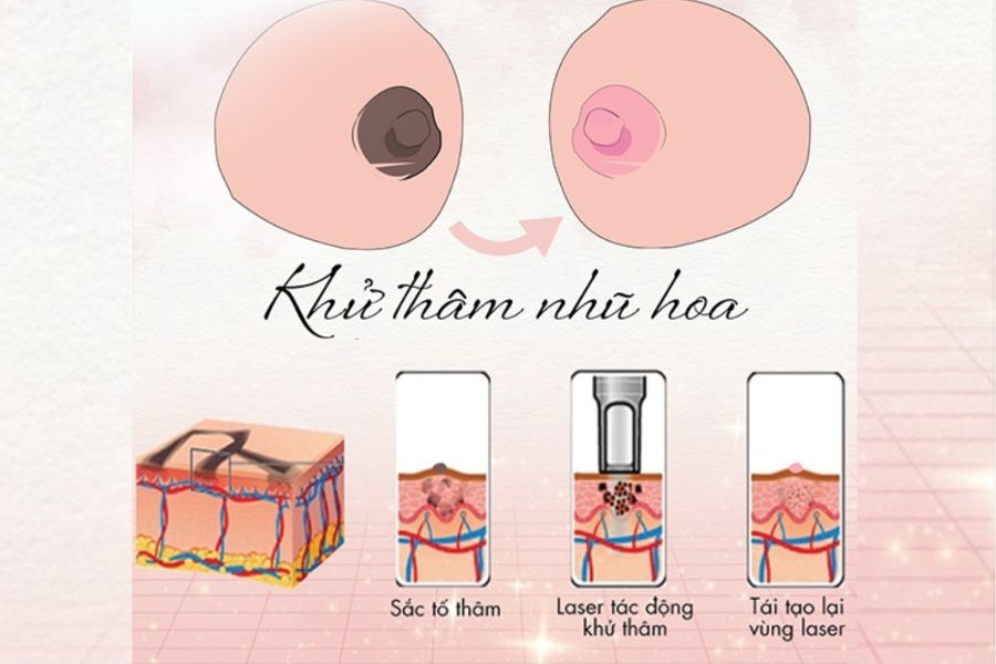Làm Hồng Nhũ Hoa – Giải Pháp Thẩm Mỹ Tinh Tế, An Toàn Cho Vòng 1 3 Nguyên Nhân Khiến Nhũ Hoa Bị Thâm Sạm