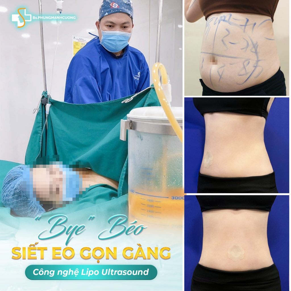 Lipo Ultrasound là gì? – Công nghệ hút mỡ siêu âm chuẩn y khoa 5 Công nghệ Lipo Ultrasound là gì