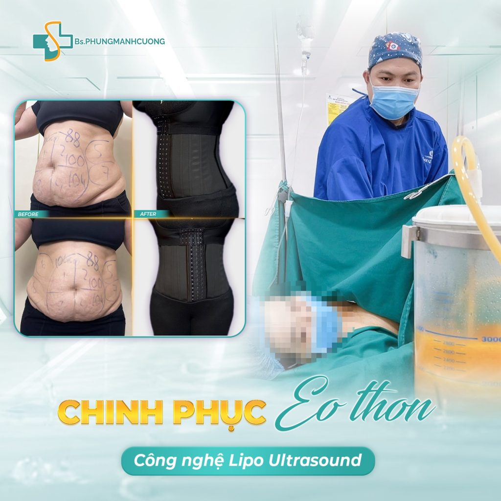Lipo Ultrasound là gì? – Công nghệ hút mỡ siêu âm chuẩn y khoa 7 Hình ảnh khách hàng sau thực hiện hút mỡ lipo ultrasound