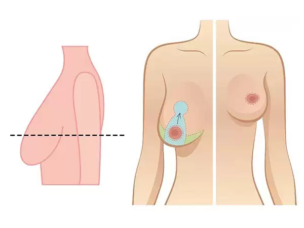 Nâng ngực giọt nước là gì? Giải pháp thẩm mỹ giúp vòng một căng tròn tự nhiên 7 Giai cuu nguc sa tre cap do 4 voi phuong phap treo sa tre duong quang cung bac si Nguyen dac Linh giai cuu 1 1678241050 25 width600height450