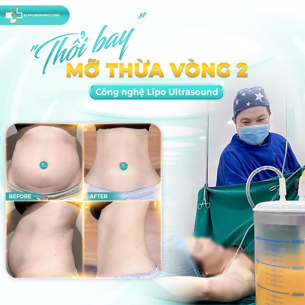 Tại sao nhu cầu giảm mỡ không phẫu thuật ngày càng tăng? 5 1. Giảm Mỡ Không Phẫu Thuật Là Gì? Nguyên Lý Hoạt Động