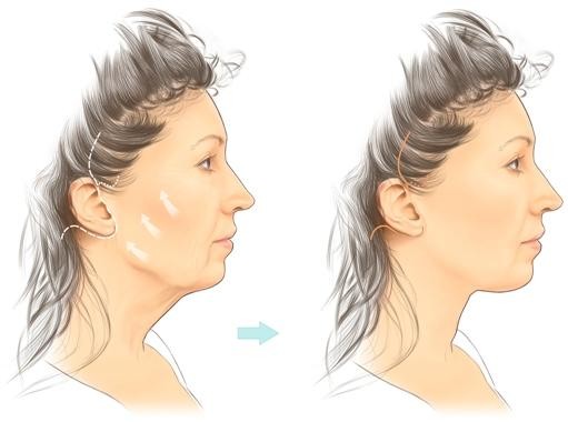 Căng Da Mặt Nội Soi Có Nguy Hiểm Không? Tìm Hiểu Toàn Diện Trước Khi Quyết Định 5 Căng da mặt nội soi có nguy hiểm không?