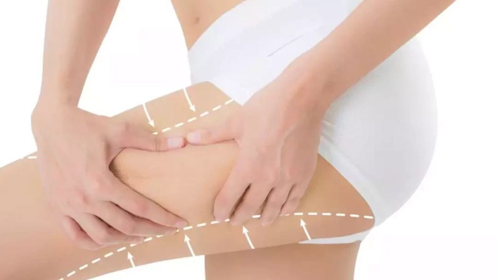 Hút mỡ đùi an toàn: Giải pháp cho đôi chân thon gọn 5 Hút mỡ đùi an toàn là gì?
