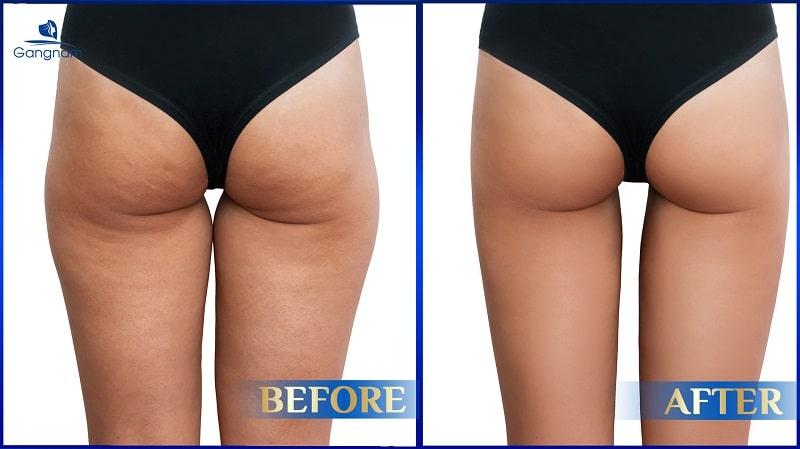 Hút Mỡ Đùi Trong Công nghệ Lipo Ultrasound – Đùi Thon Đẹp Tự Nhiên 10 Hình ảnh khách hàng trước và sau khi hút mỡ đùi trong bằng Lipo Ultrasound