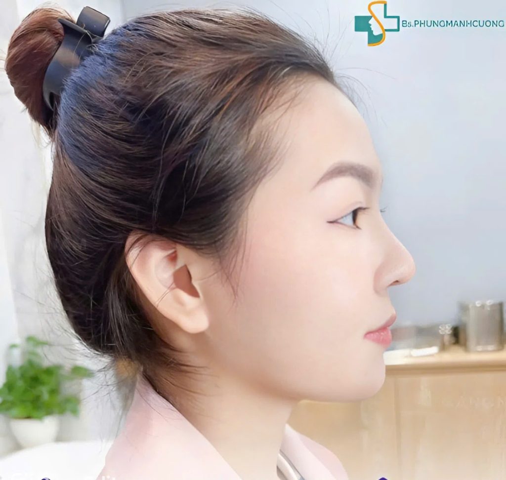 Nâng mũi sụn sườn là gì? Giải đáp từ chuyên gia 6 Ưu điểm nổi bật của nâng mũi sụn sườn là gì?