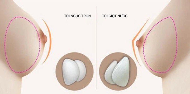 Nâng ngực giọt nước là gì? Giải pháp thẩm mỹ giúp vòng một căng tròn tự nhiên 6 Nâng ngực giọt nước là gì?