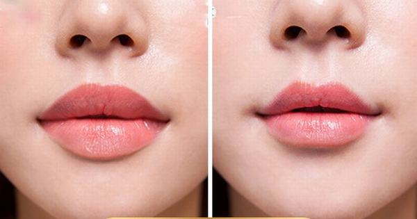 Phẫu thuật thu mỏng môi: Giải pháp cho đôi môi cân đối và hài hòa 6 Phẫu thuật thu mỏng môi là gì?