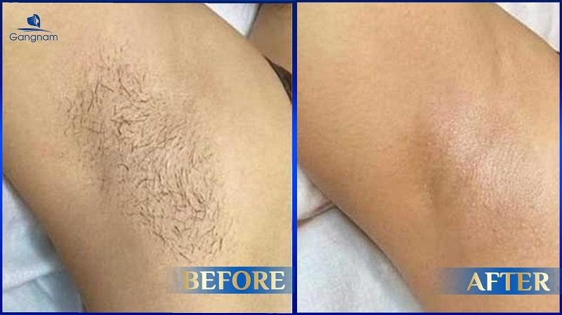 TRIỆT LÔNG VÙNG KÍN HIỆU QUẢ: Giải pháp an toàn & tự tin cho phái đẹp 6 Kết quả triệt lông tại BS.Phùng Mạnh Cường