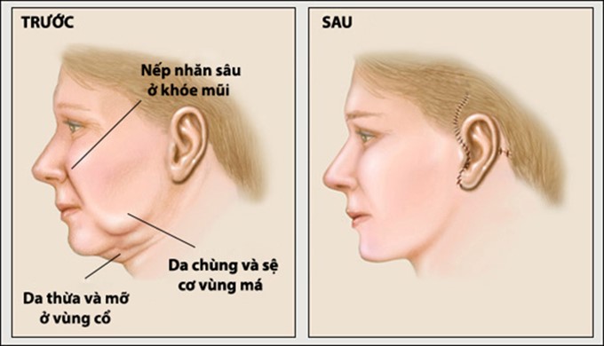 Phẫu thuật căng da mặt: Giải pháp trẻ hóa toàn diện 5 Phẫu thuật căng da mặt là gì?