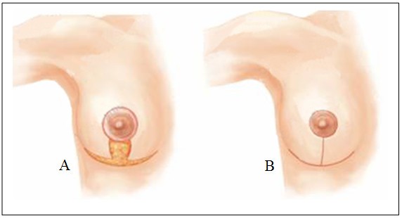 Thu Nhỏ Quầng Vú Bao Lâu Lành? Hướng Dẫn Chăm Sóc Đúng Cách Từ Chuyên Gia 6 Thu Nhỏ Quầng Vú Là Gì và Ai Là Đối Tượng Phù Hợp