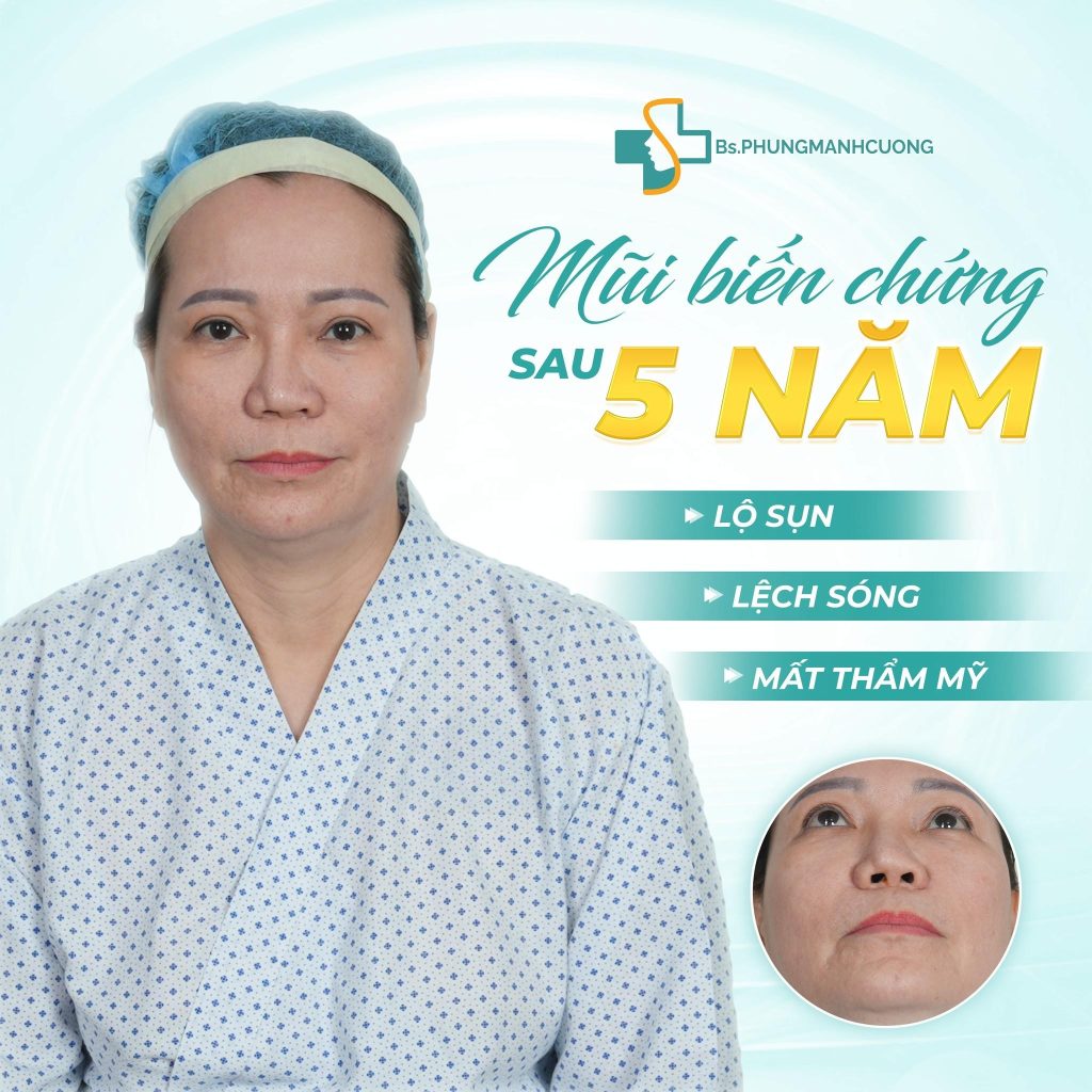 KINH NGHIỆM SỬA MŨI – NHỮNG BÀI HỌC ĐẮT GIÁ ĐỂ KHÔNG “TIỀN MẤT TẬT MANG” 5 Vì Sao Phải Sửa Mũi? – Khi “Thẩm Mỹ Lỗi”