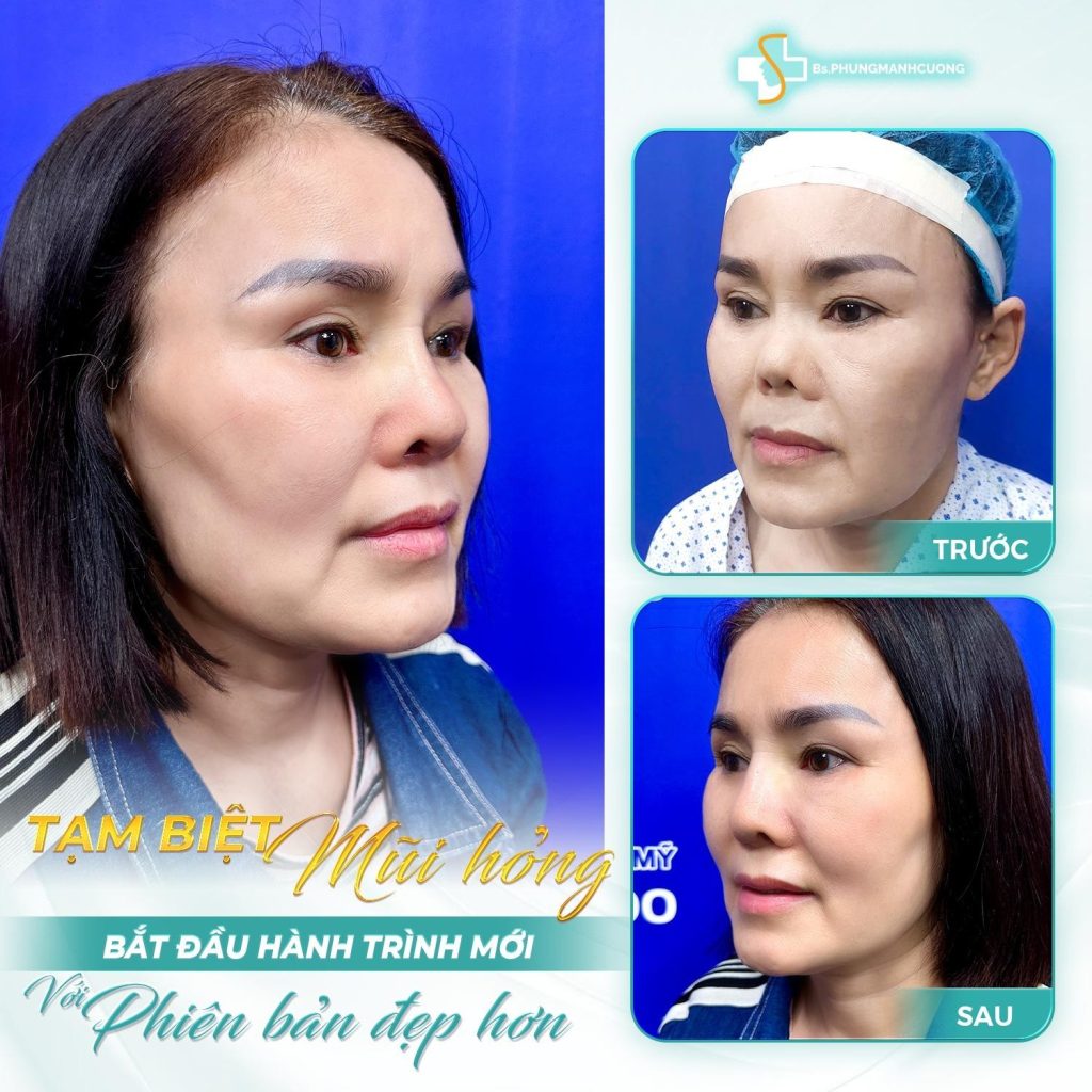 KINH NGHIỆM SỬA MŨI – NHỮNG BÀI HỌC ĐẮT GIÁ ĐỂ KHÔNG “TIỀN MẤT TẬT MANG” 6 Kinh Nghiệm Sửa Mũi Khi Chọn Bác Sĩ: Quan Trọng Hơn Cả Giá Tiền