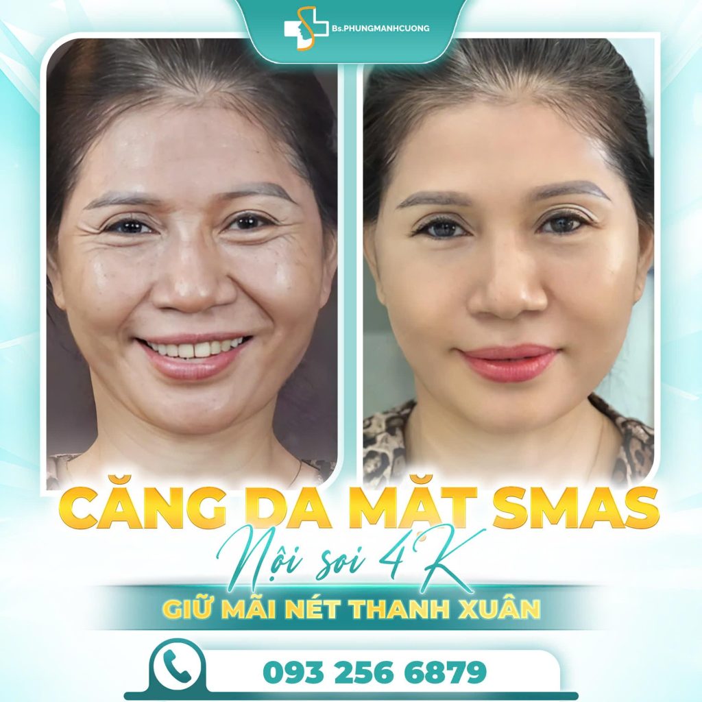Căng da mặt nội soi ở đâu đẹp nhất 