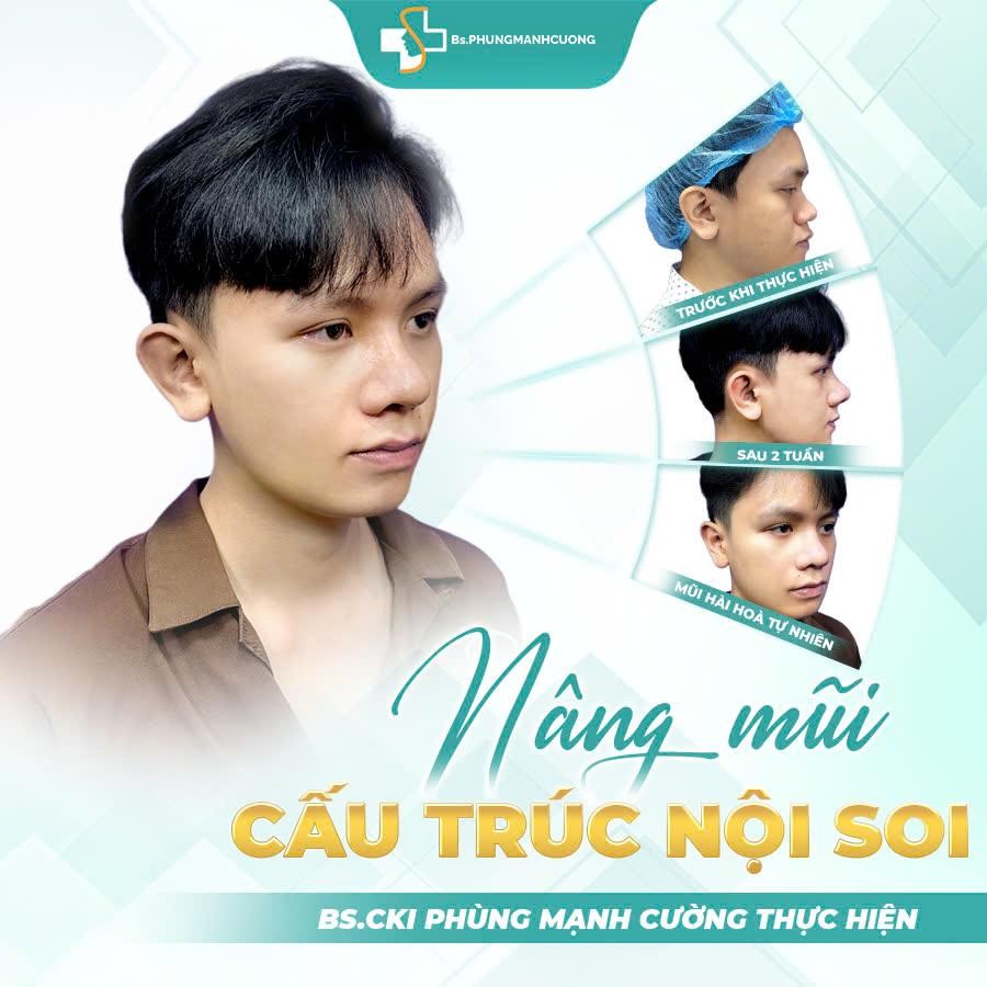 Nâng Mũi Bác Sĩ Phùng Mạnh Cường Có Gì Khác Biệt? – Khi Niềm Tin Hội Tụ Cùng Kỹ Thuật Thẩm Mỹ 6 Ai Phù Hợp Với Dịch Vụ Nâng Mũi Bác Sĩ Phùng Mạnh Cường?